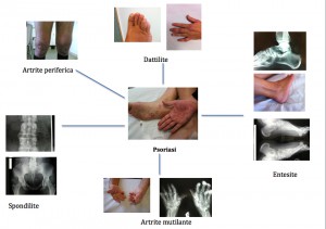 le varianti di artrite psoriasica