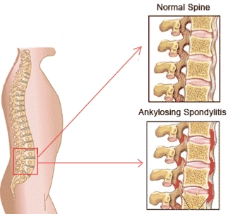 spondilite anchilosante 01
